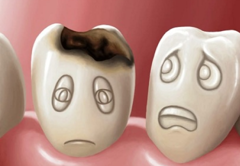 Hướng Dẫn Cách Phòng Ngừa Sâu Răng Tại Nhà